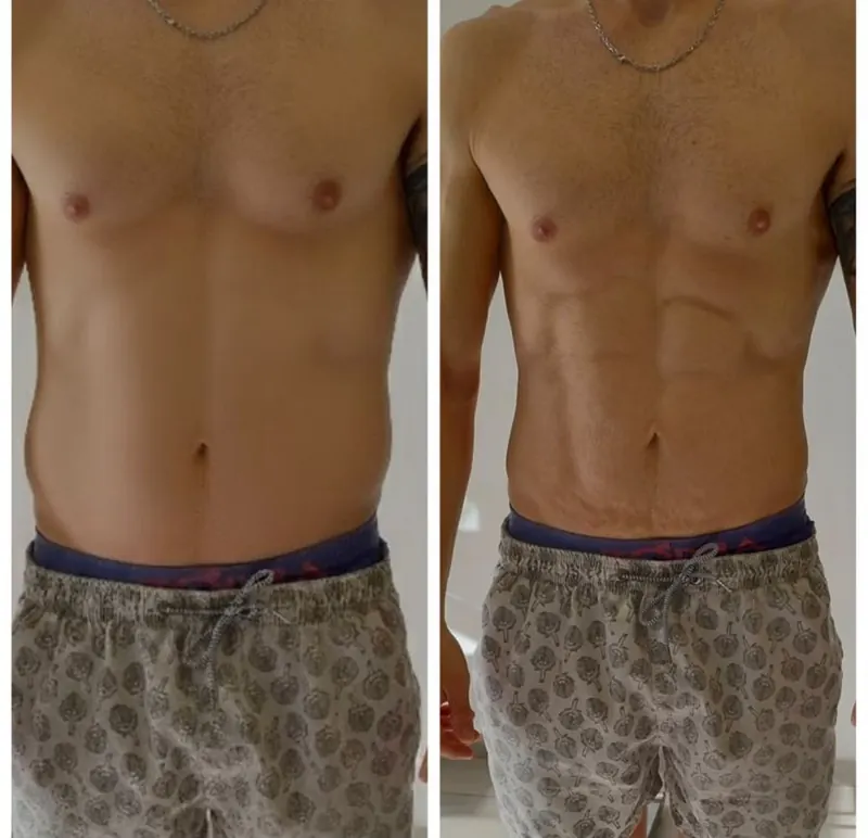 Comparación de abdomen de un paciente: antes y después del plan de alimentación y entrenamiento
